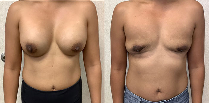 Breast Implant Removal, Orange County, CA