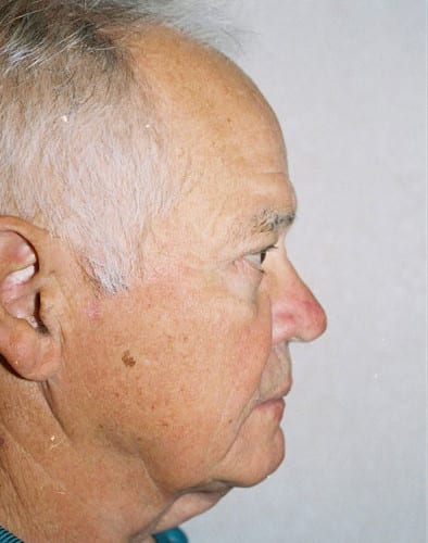 Male Cosmetic Surgery 02 After Photo