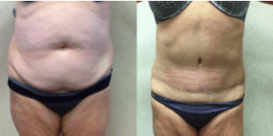 What Can I Expect After a Tummy Tuck?