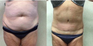 Why Do I Need Compression After a Tummy Tuck?