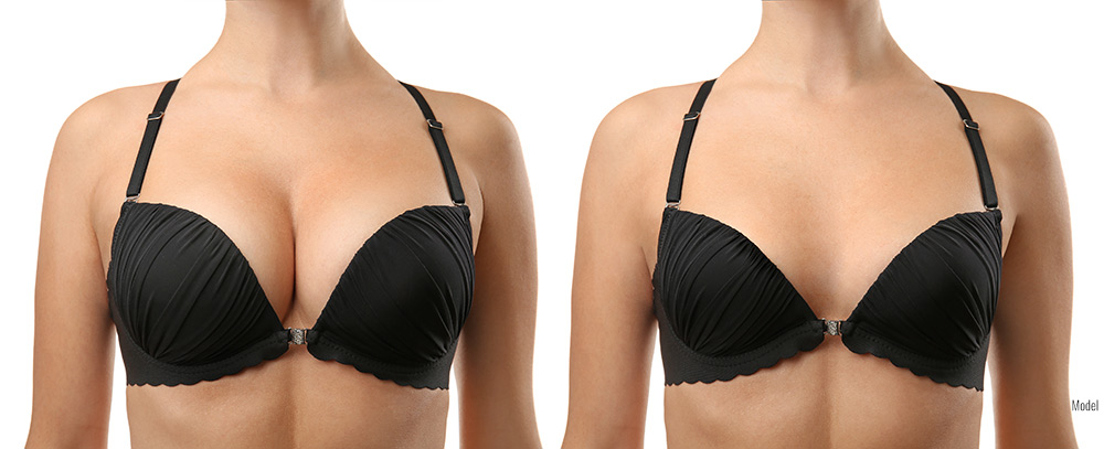 Before and after photos following a breast correction.