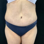 Abdominoplasty 19 After Thumbnail Photo