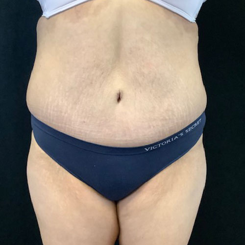 Abdominoplasty 19 After Photo