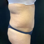 Abdominoplasty 19 After Thumbnail Photo