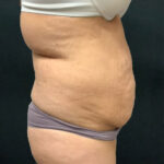 Abdominoplasty 19 Before Thumbnail Photo