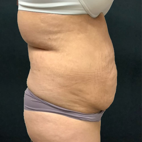 Abdominoplasty 19 Before Photo