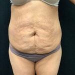 Abdominoplasty 19 Before Thumbnail Photo