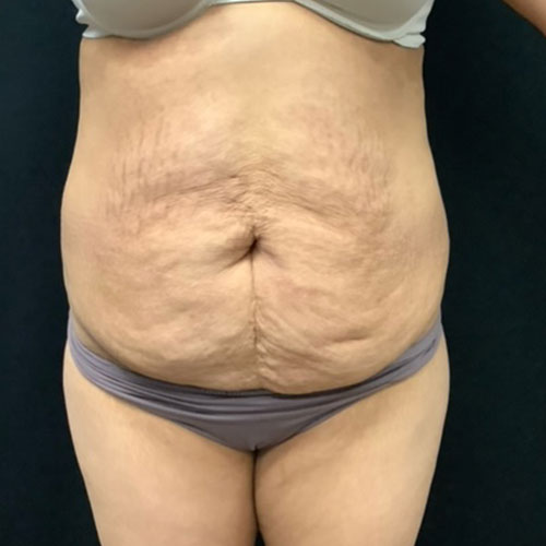 Abdominoplasty 19 Before Photo